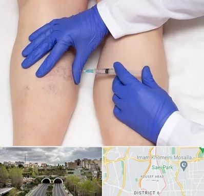 اسکلروتراپی در یوسف آباد 