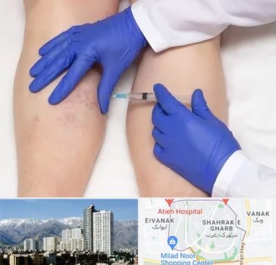 اسکلروتراپی در شهرک غرب 