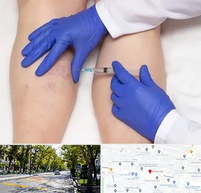 اسکلروتراپی در میرداماد 