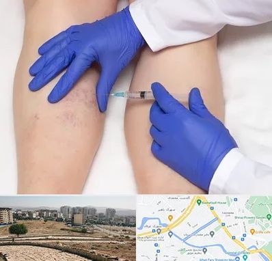 اسکلروتراپی در کوی وحدت شیراز