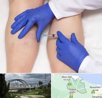 اسکلروتراپی در چالوس