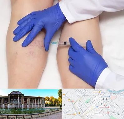 اسکلروتراپی در عفیف آباد شیراز