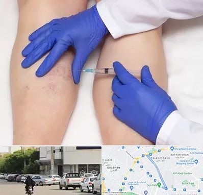 اسکلروتراپی در قدوسی شرقی شیراز