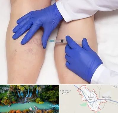 اسکلروتراپی در دورود