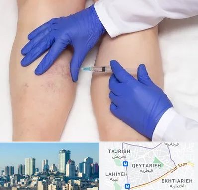 اسکلروتراپی در قیطریه 