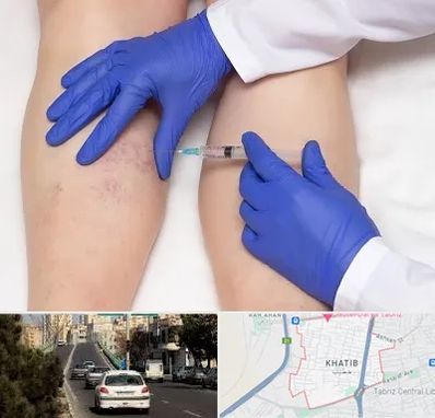 اسکلروتراپی در خطیب تبریز