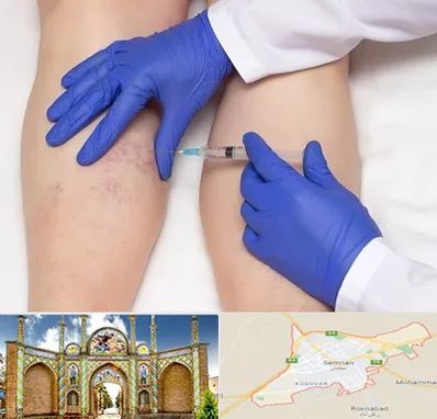 اسکلروتراپی در سمنان