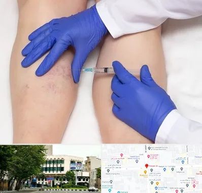 اسکلروتراپی در طالقانی 