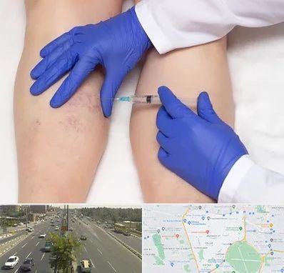 اسکلروتراپی در منطقه 17 تهران 