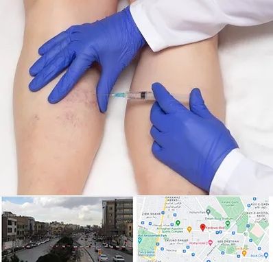 اسکلروتراپی در بلوار فردوسی مشهد 