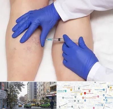 اسکلروتراپی در فاطمی 