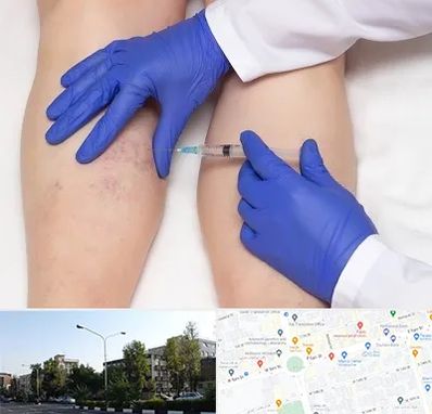 اسکلروتراپی در میدان کاج 