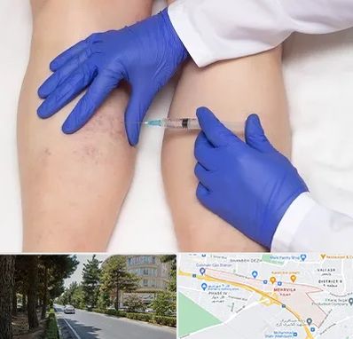 اسکلروتراپی در مهرویلا کرج