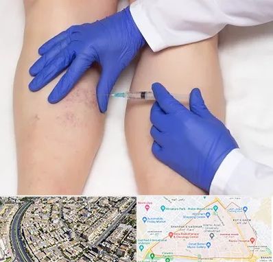 اسکلروتراپی در شهرک غرب مشهد
