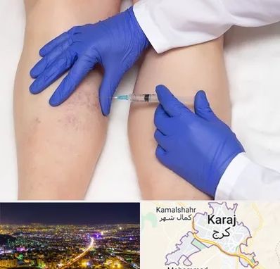 اسکلروتراپی در کرج