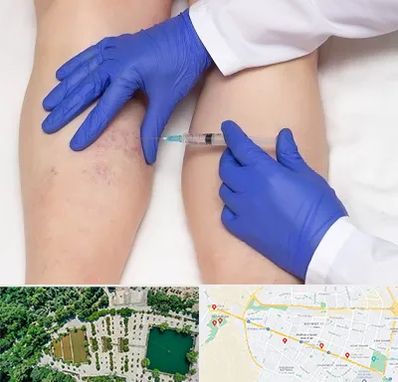 اسکلروتراپی در وکیل آباد مشهد 