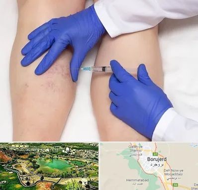 اسکلروتراپی در بروجرد