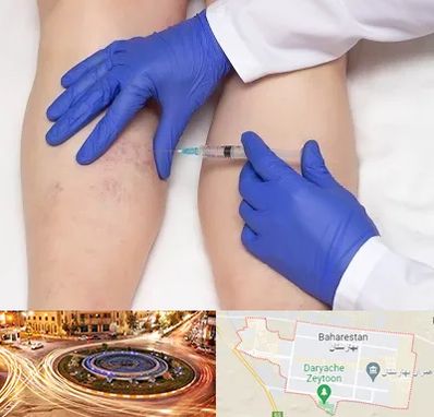 اسکلروتراپی در بهارستان