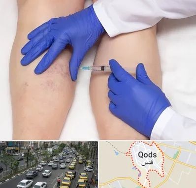 اسکلروتراپی در شهر قدس