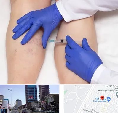 اسکلروتراپی در چهارراه طالقانی کرج