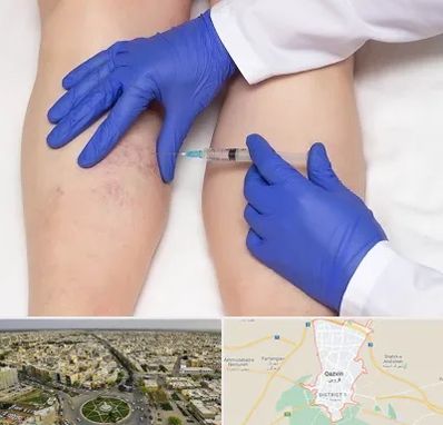 اسکلروتراپی در قزوین