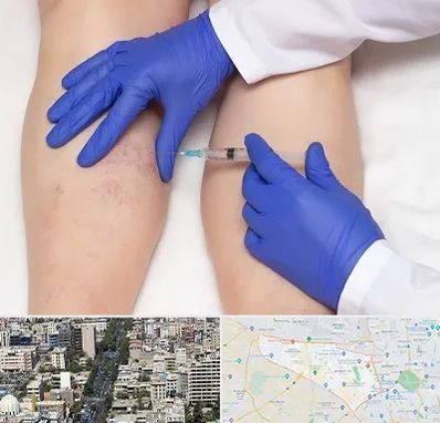 اسکلروتراپی در منطقه 18 تهران 