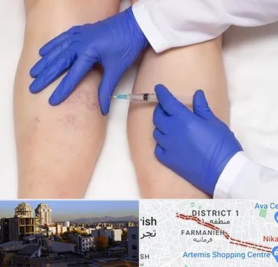 اسکلروتراپی در فرمانیه 