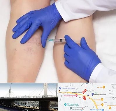 اسکلروتراپی در پارک وی 