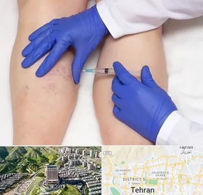 اسکلروتراپی در شمال تهران 