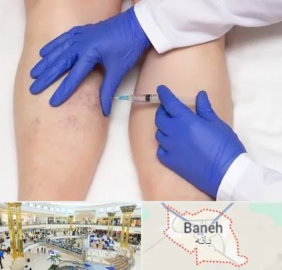 اسکلروتراپی در بانه