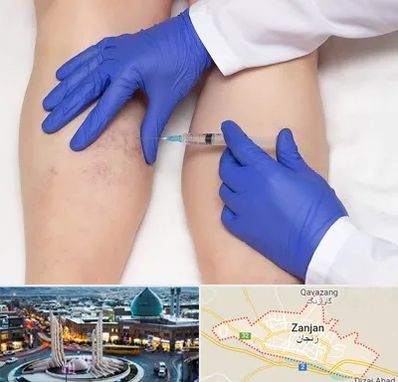 اسکلروتراپی در زنجان