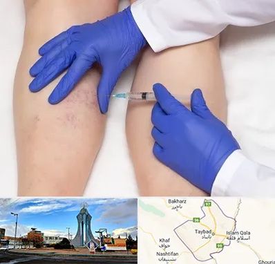 اسکلروتراپی در تایباد