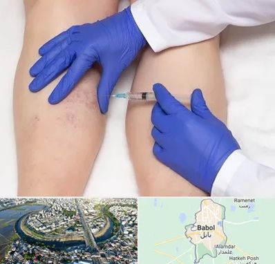 اسکلروتراپی در بابل