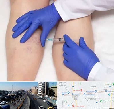 اسکلروتراپی در پیروزی 