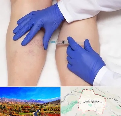 اسکلروتراپی در خراسان شمالی