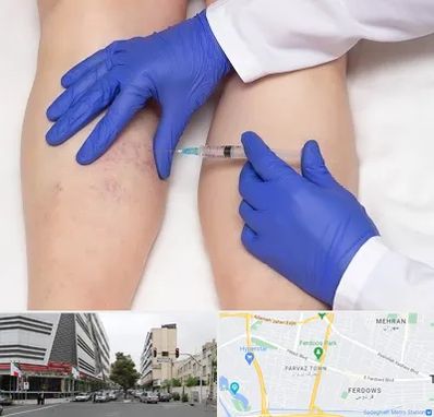 اسکلروتراپی در بلوار فردوس 