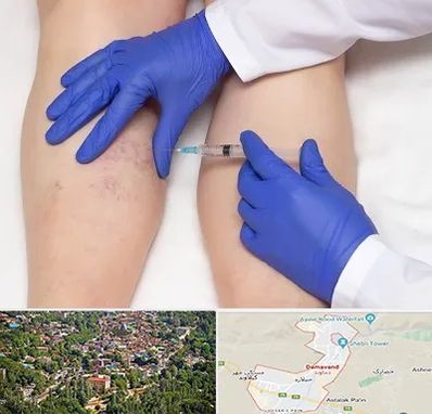 اسکلروتراپی در دماوند