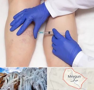 اسکلروتراپی در میگون