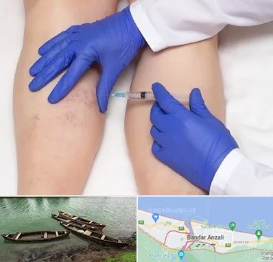 اسکلروتراپی در بندر انزلی