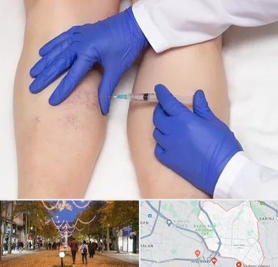 اسکلروتراپی در ولیعصر ارومیه