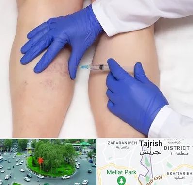 اسکلروتراپی در تجریش 