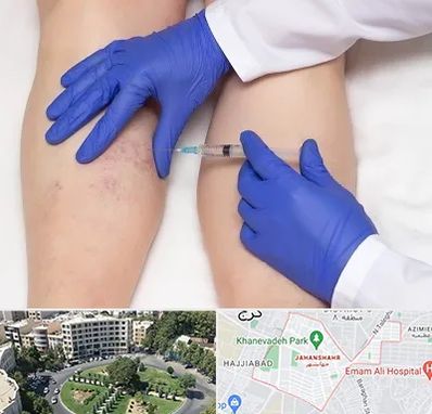 اسکلروتراپی در جهانشهر کرج 