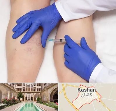 اسکلروتراپی در کاشان