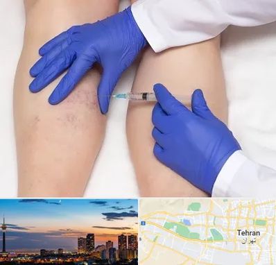 اسکلروتراپی در غرب تهران 
