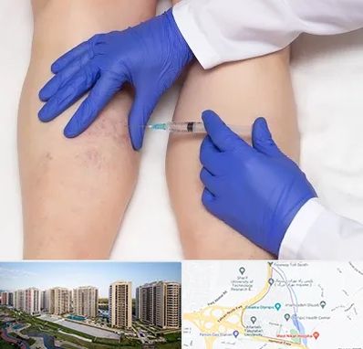 اسکلروتراپی در المپیک 