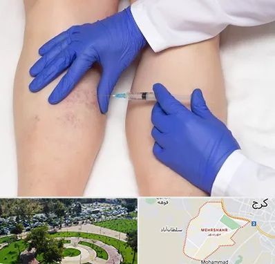 اسکلروتراپی در مهرشهر کرج 