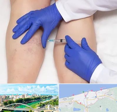 اسکلروتراپی در بابلسر