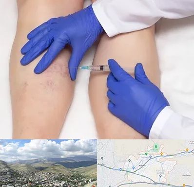 اسکلروتراپی در رودهن