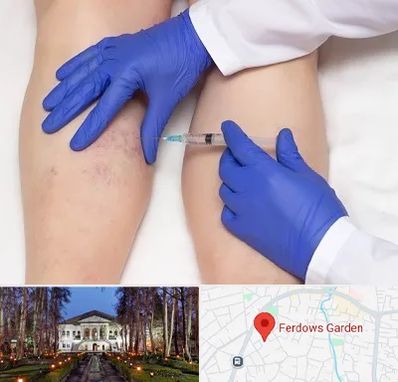 اسکلروتراپی در باغ فردوس