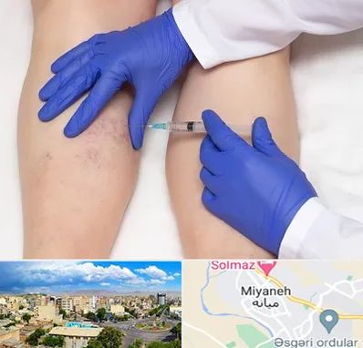 اسکلروتراپی در میانه